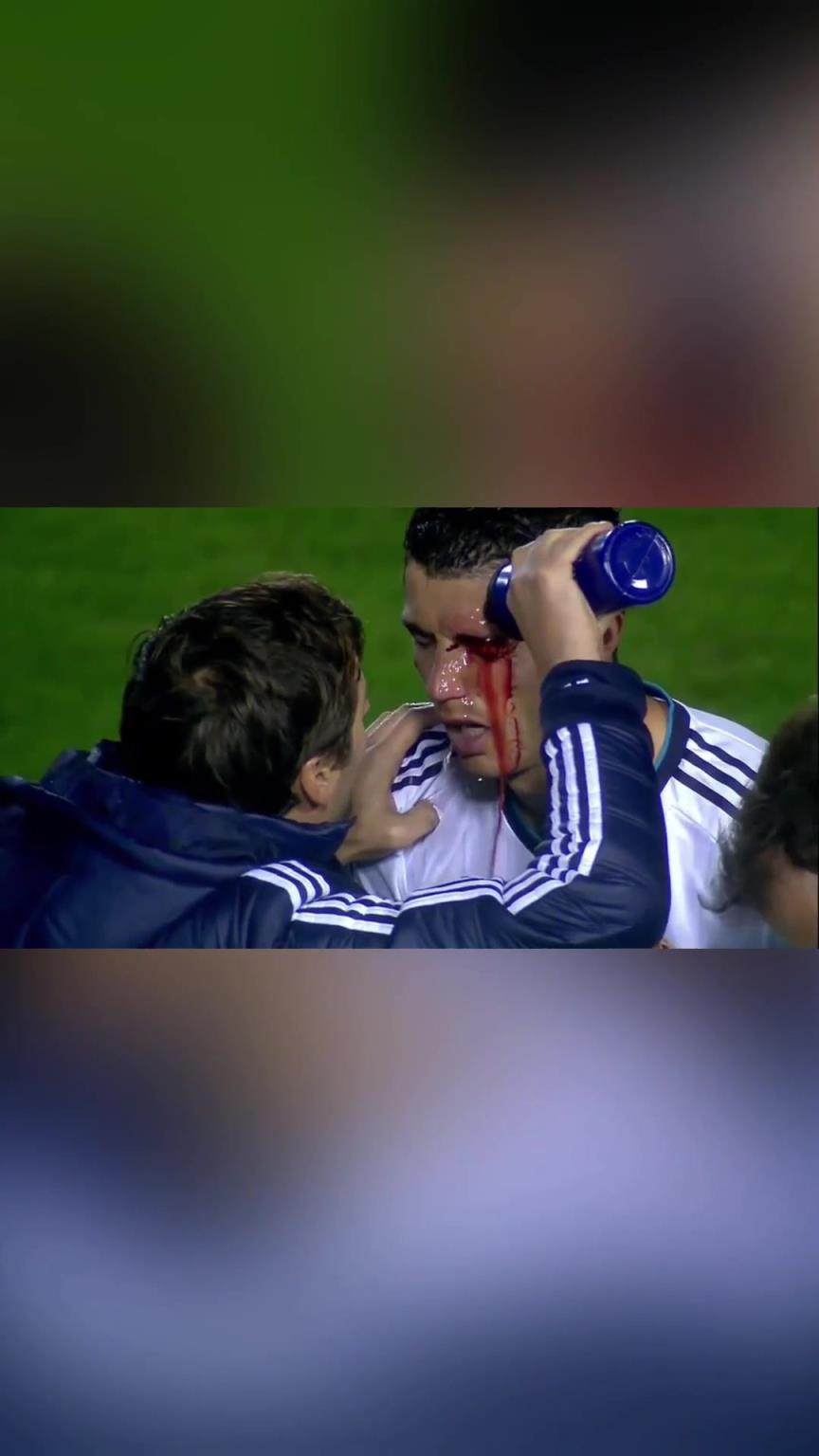 硬汉!C罗眉骨破裂现场缝针,单眼进球霸气回击对手!